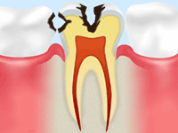 虫歯は早めの治療が肝心です